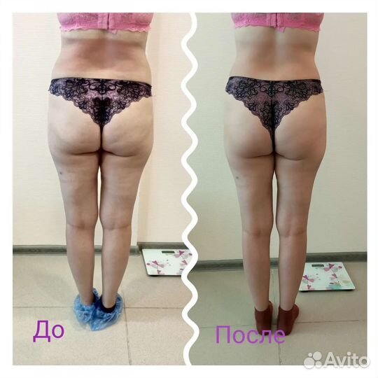 Аппаратный массаж