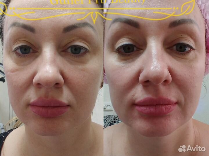 Микроигольчатый Рф-лифтинг