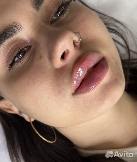 TCA-пилинг лица