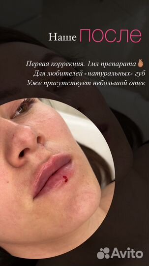 Увеличение губ