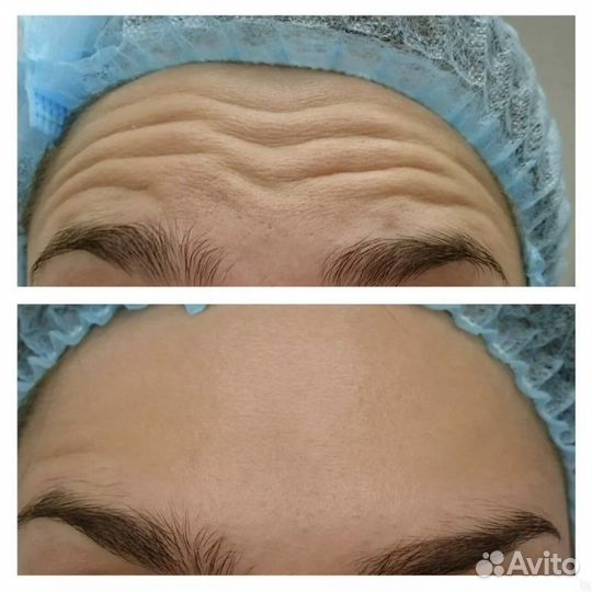 Требуются модели на ботокс