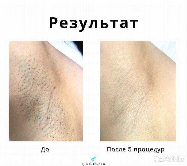 Аппарат для эпиляции люминес Макс-Ван 1200W