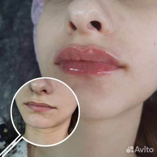 Увеличение губ
