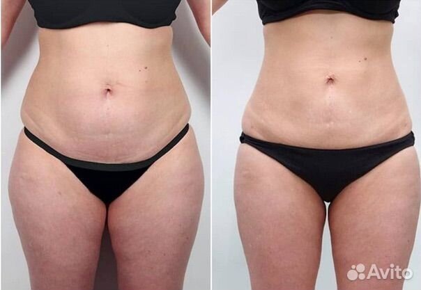 Удаление жира, криолиполиз в ульяновске