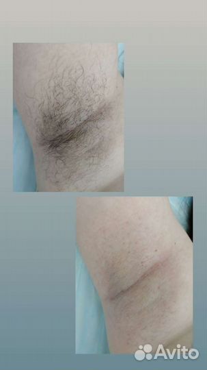 Шугаринг. Воск