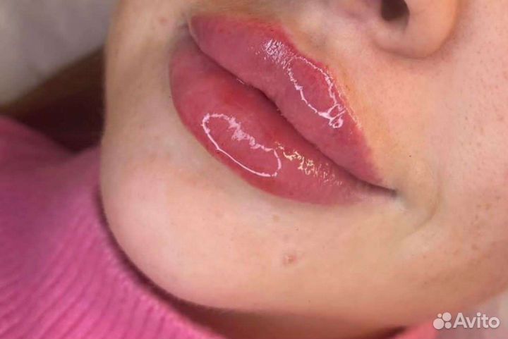 Биоревитализация