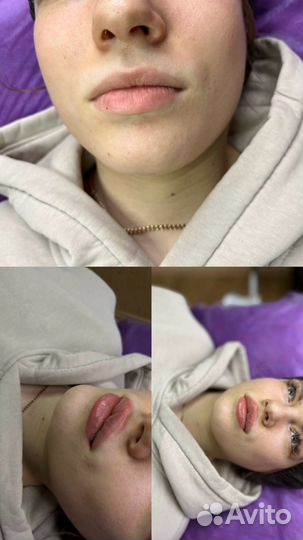 Модель на увеличение губ