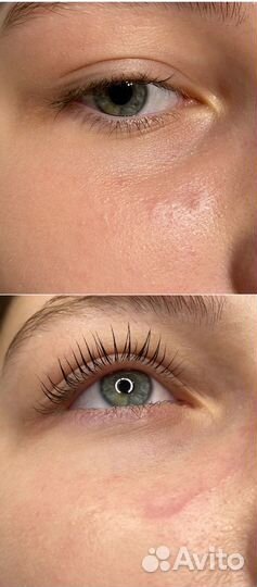 Липолитики тела, лицо