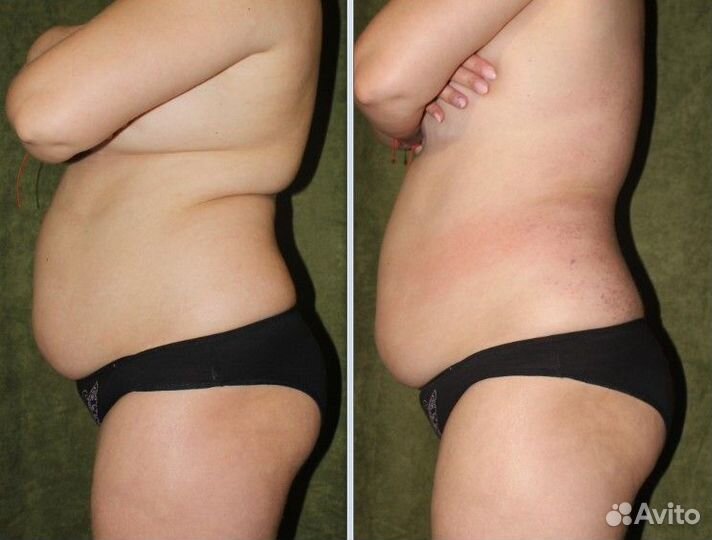 Вибромассаж для похудения