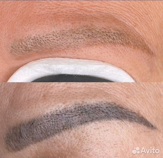 Лазерное удаление тату