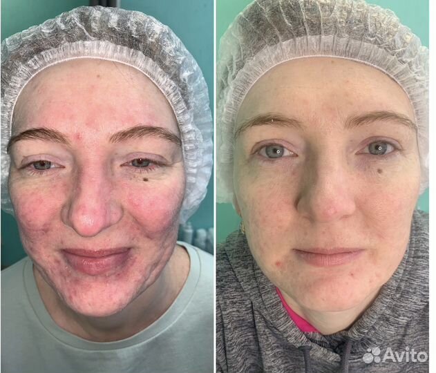 Холодная плазма + обучение