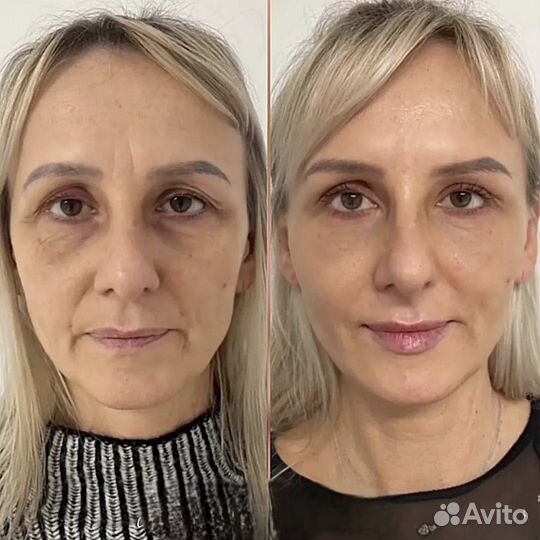 Косметолог: Лицо под ключ, филлеры