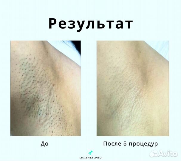 Диодный лазер для эпиляции Lumines Макс’Ван 1200W