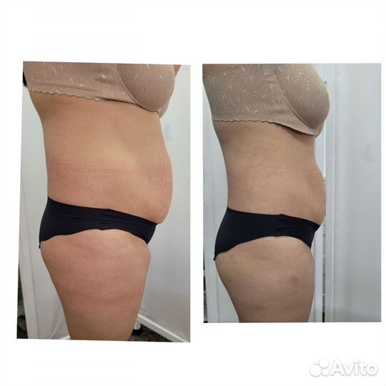 Lpg массаж тела