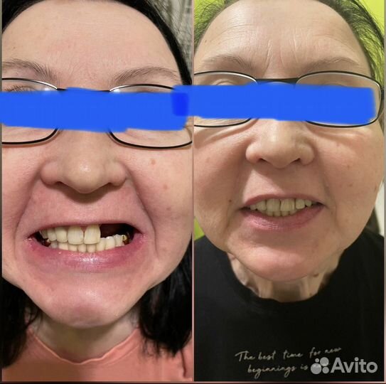 Зубные протезы