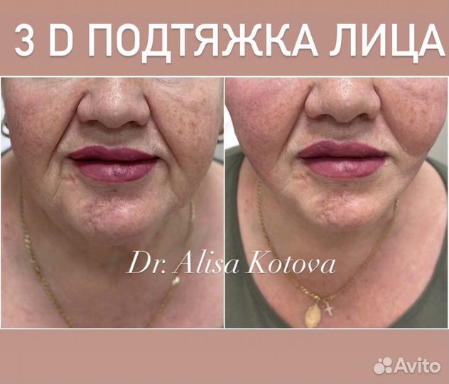 Косметология увеличение губ мезонити