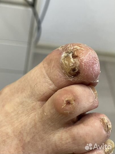 Лечебный педикюр выезд на дом подолог