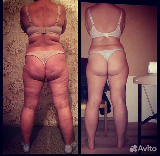 Вакуумный массаж Куюки ЖК светлый