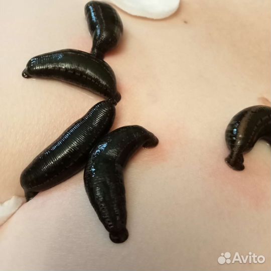 Купон на сеанс Гирудотерапии/ Косметологии