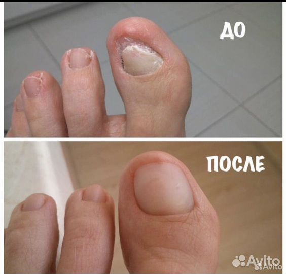 Медицинский педикюр,подолог