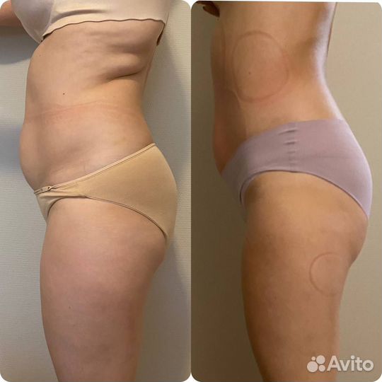 Аппаратная коррекция фигуры, антицеллюлитная