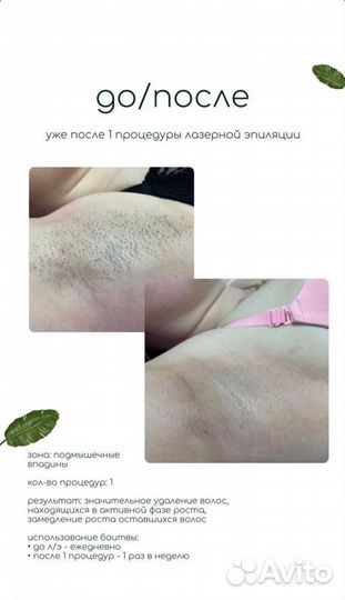 Лазерная эпиляция