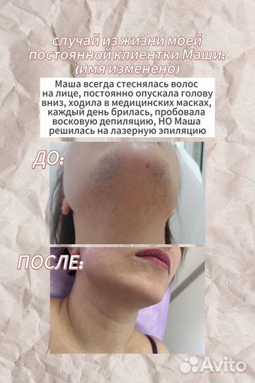 Лазерная эпиляция