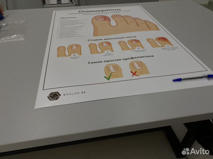 Плакат онихокриптоз