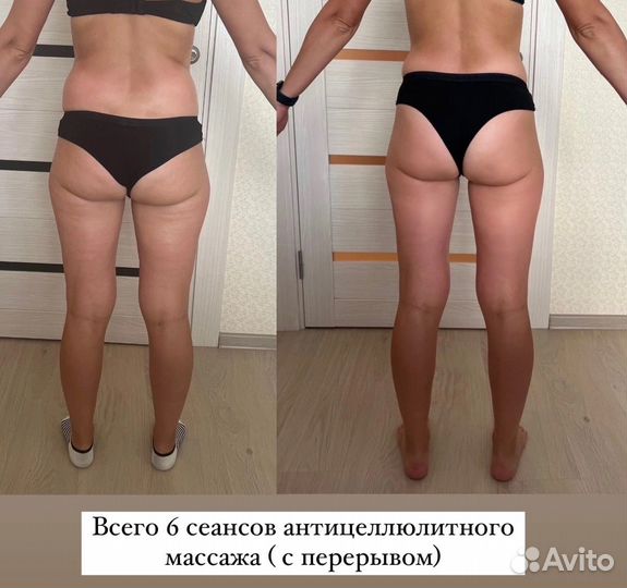 Антицеллюлитный массаж