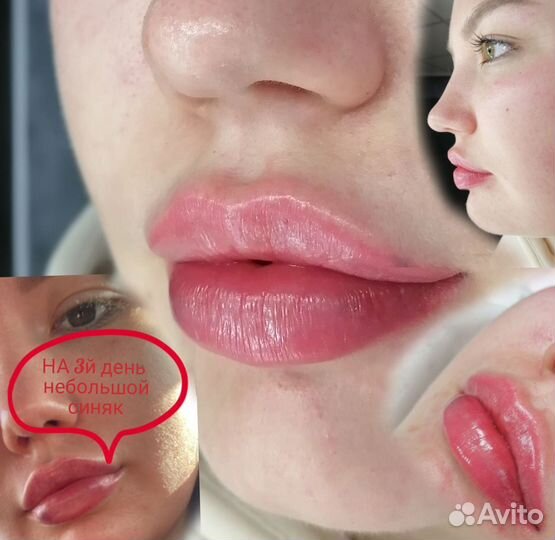 Увеличение губ