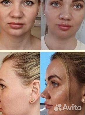 Лифтинг эффект