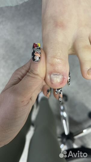 Педикюр, титановые нити, сложные стопы