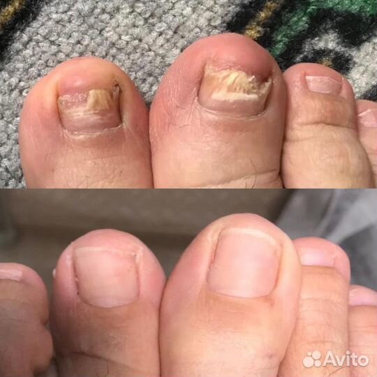 Педикюр медицинский / подолог