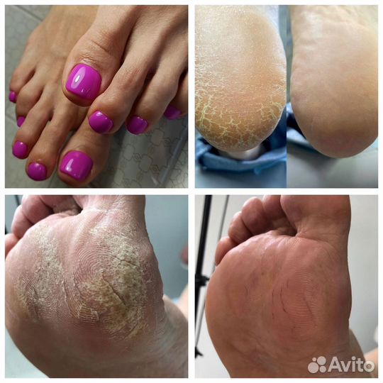 Педикюр. Лечебный педикюр