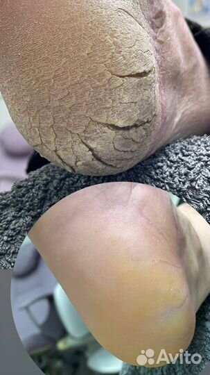 Педикюр Подолог