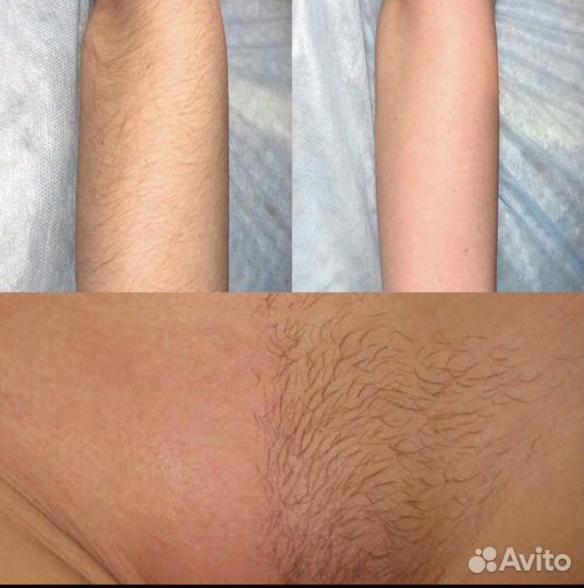 Шугаринг: глубокое бикини