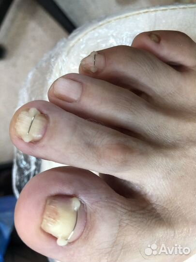 Подологический педикюр