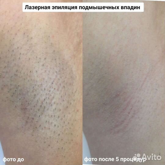 Лазерная эпиляция