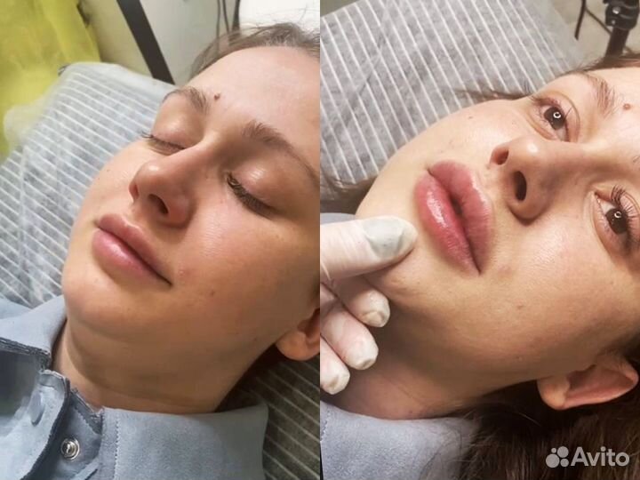 Услуги косметолога. Мезотерапия