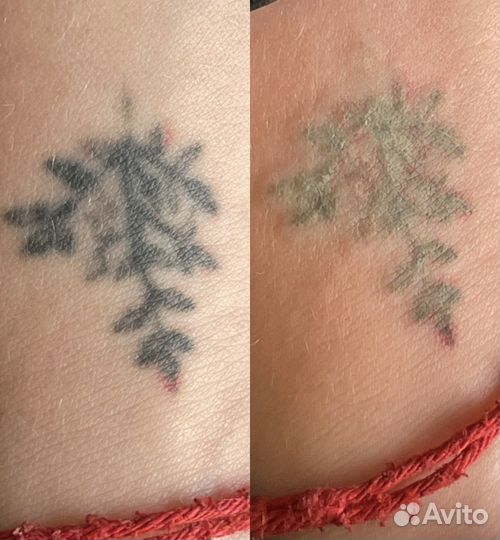 Удаление татуажа татуировок лазером ремувером